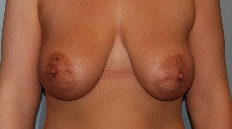 Behandelingen - borstcorrectie - Slappe borsten voor