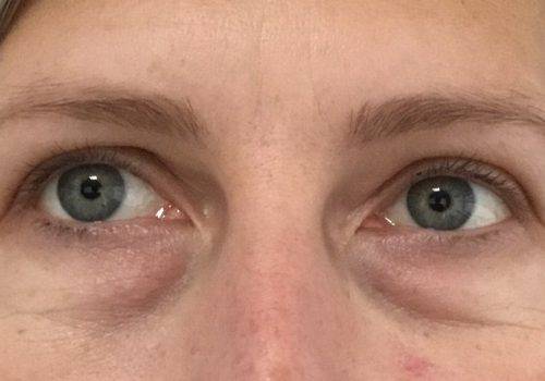 prijs Toestand mond Donkere kringen onder uw ogen verwijderen | ABC Clinic
