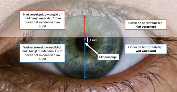 Ooglidcorrectie vergoeding