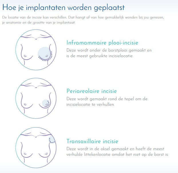 Hoe je borstimplantaten worden geplaatst